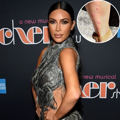 What Does Kim Kardashian's Skin Look Like With Psoriasis? Pictures of Breakouts She's Shared