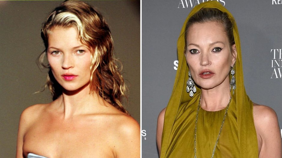 Did Kate Moss Get Plastic Surgery? Her Transformation Photos