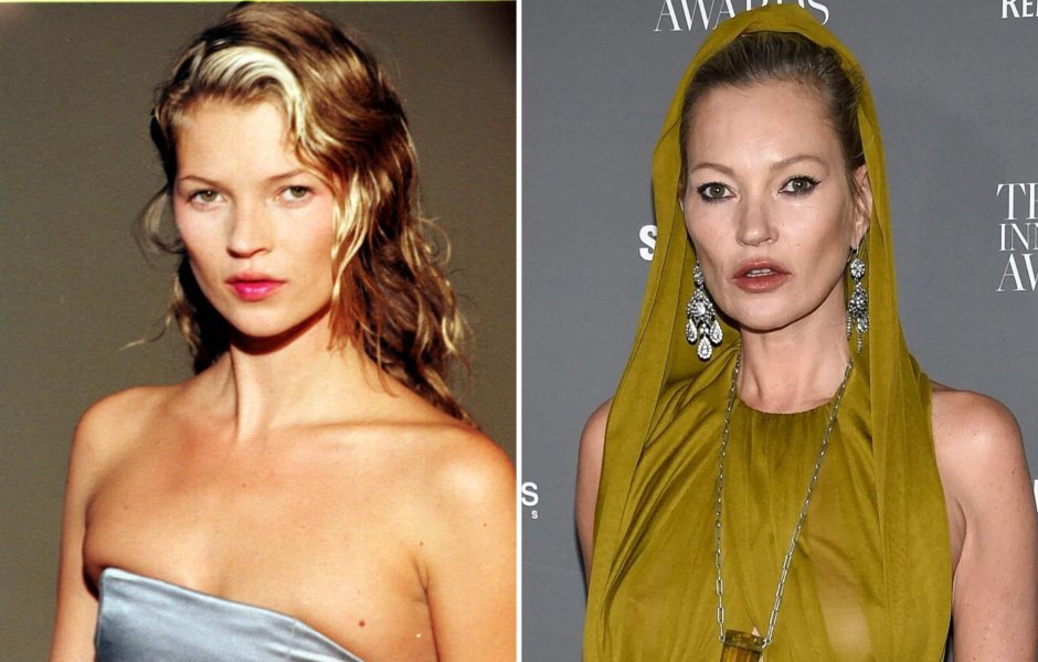 Did Kate Moss Get Plastic Surgery? Her Transformation Photos