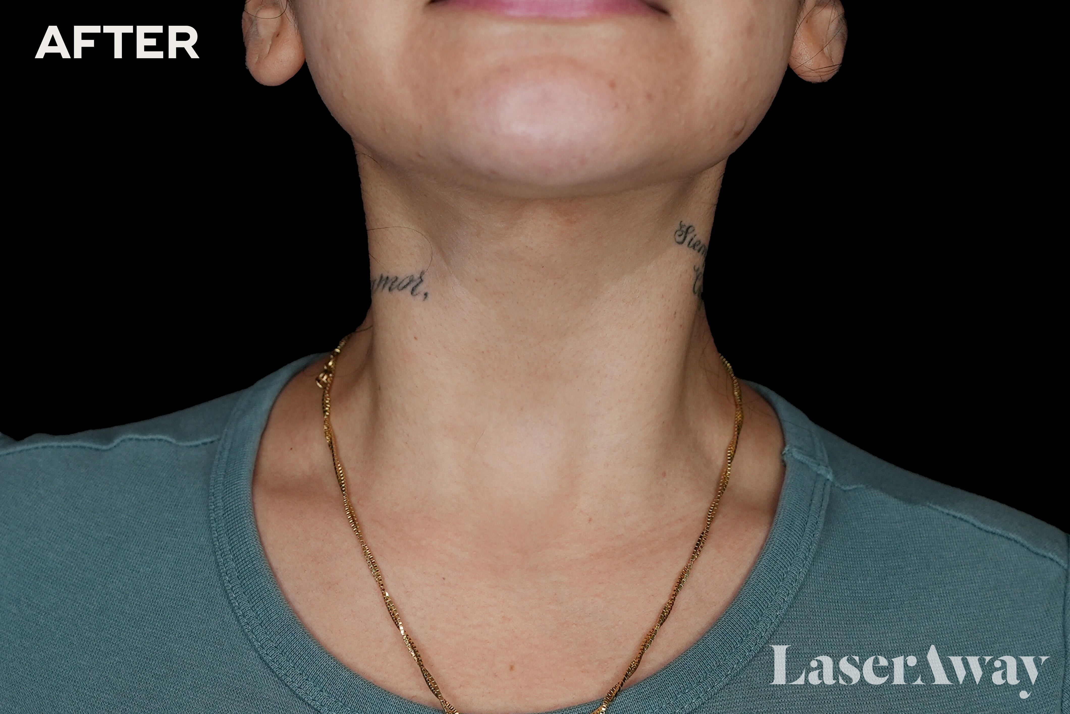 Skin Check-In With Dr. Will: How to Improve Skin Fitness in Your Neck Area With Injections