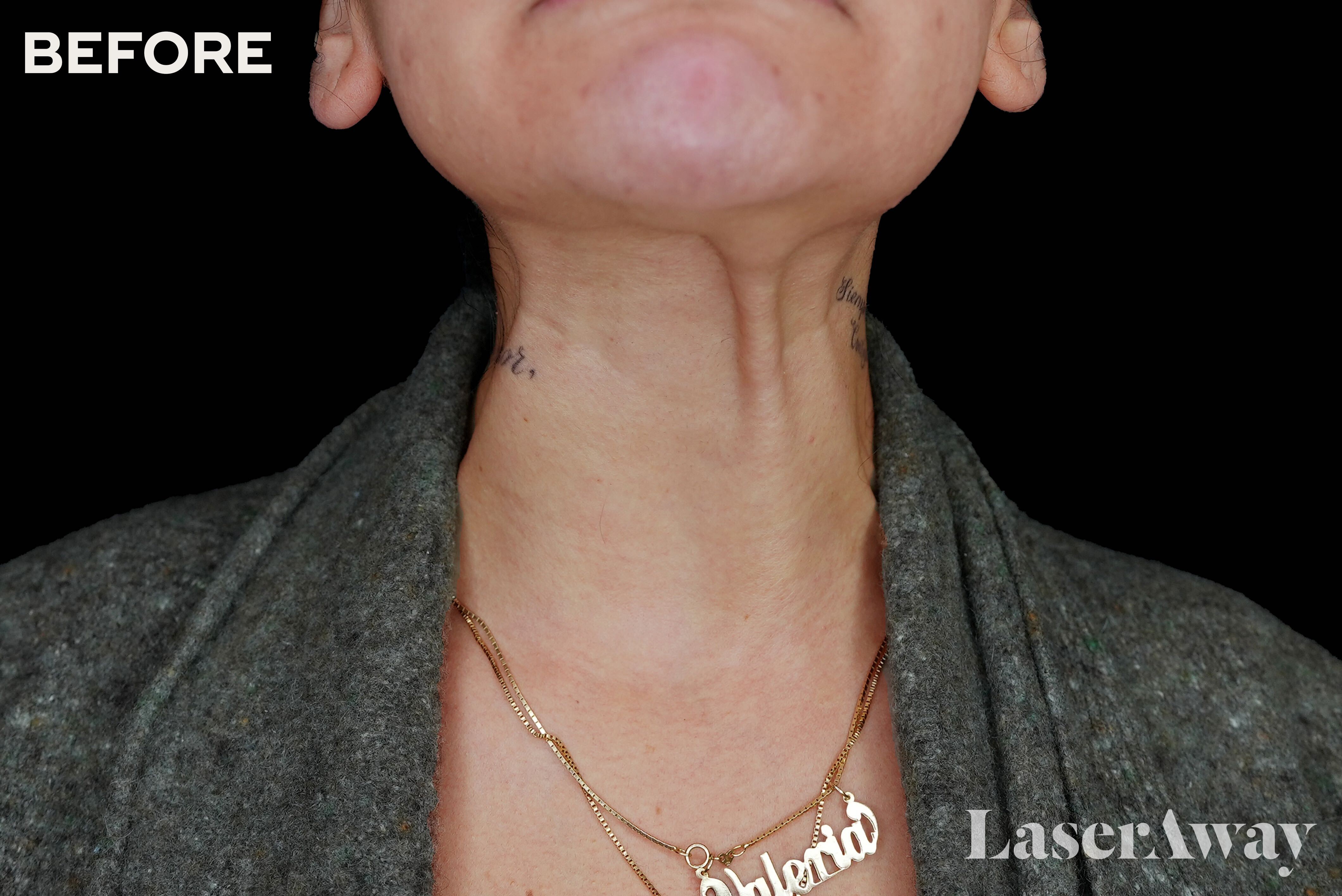 Skin Check-In With Dr. Will: How to Improve Skin Fitness in Your Neck Area With Injections