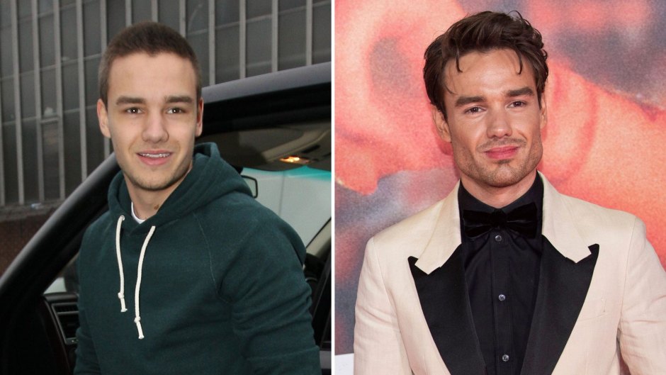 Did Liam Payne Ever Get Plastic Surgery? See Photos of His Transformation: Jaw, Face, More