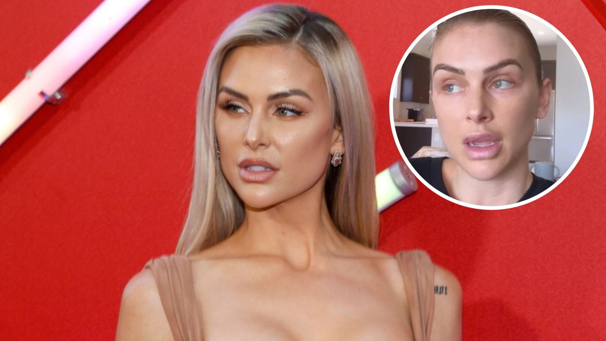 lala kent lip injections