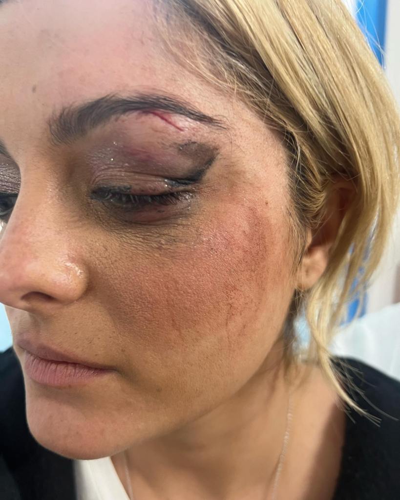 bebe-rexha-black-eye