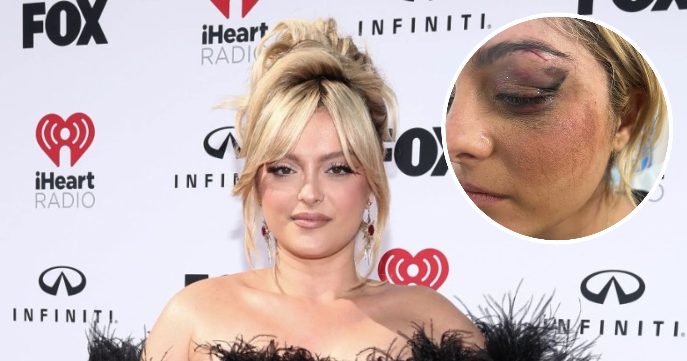 Bebe Rexha Facial Injuries: Hit By Phone In Concert - Vimarsana News