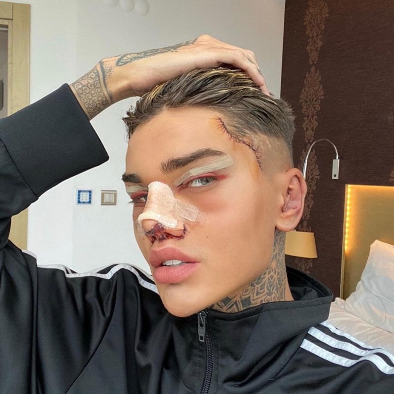Levi Jed Murphy Plastic Surgery Transformation: Before, After Photos