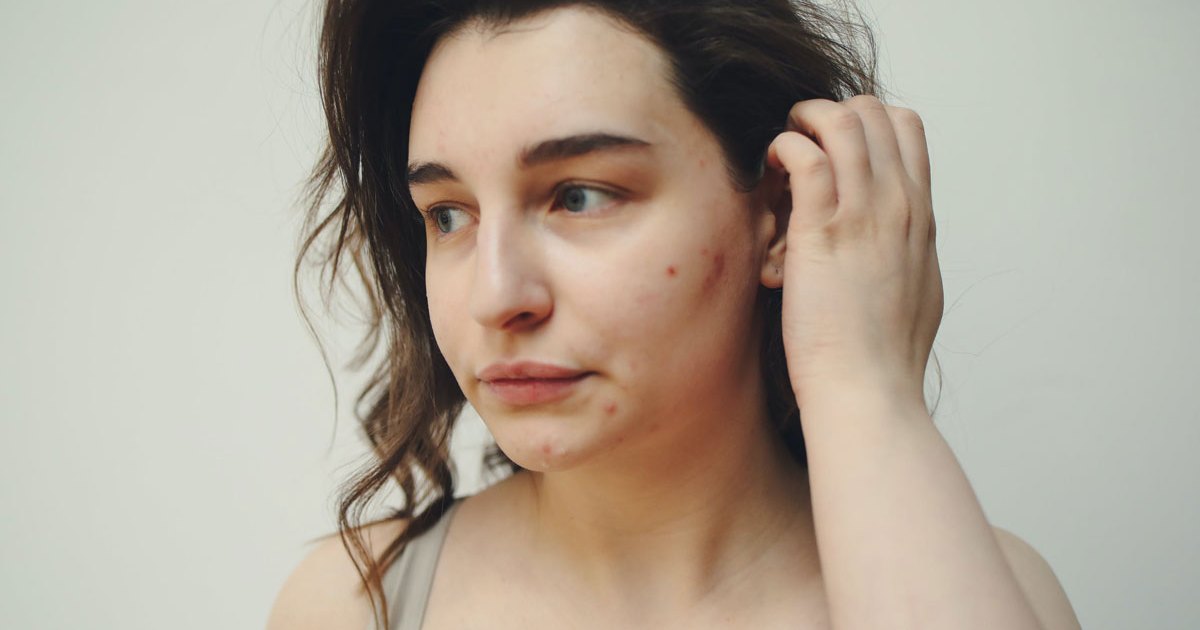 6 Zit-Zapping Products to Gift Yourself this Holiday Season