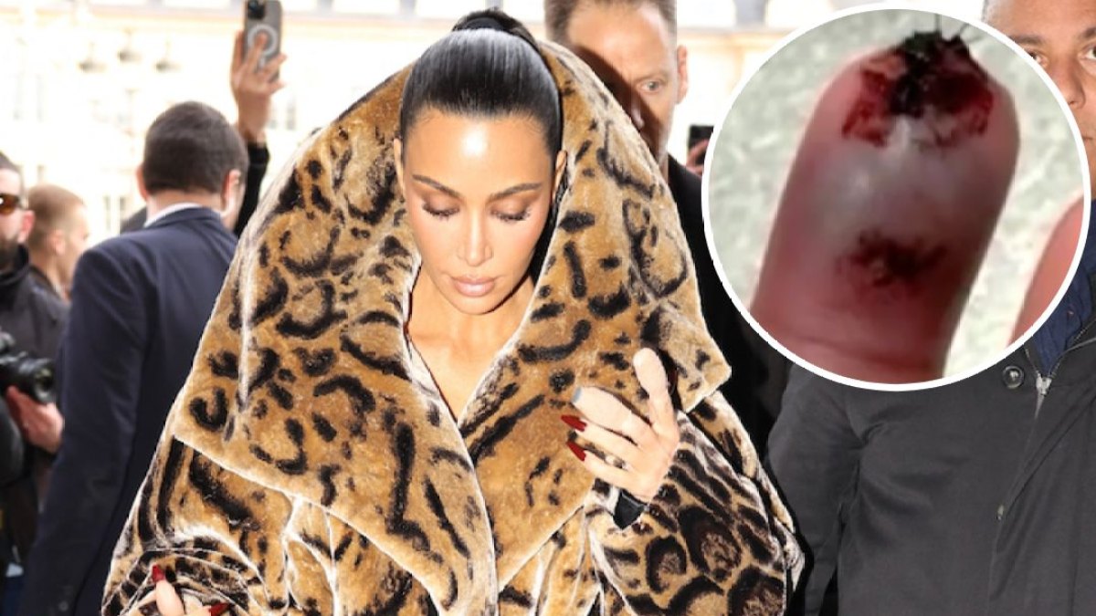Kim Kardashian's ‘Bone Was Sticking Out’ After Finger Injury