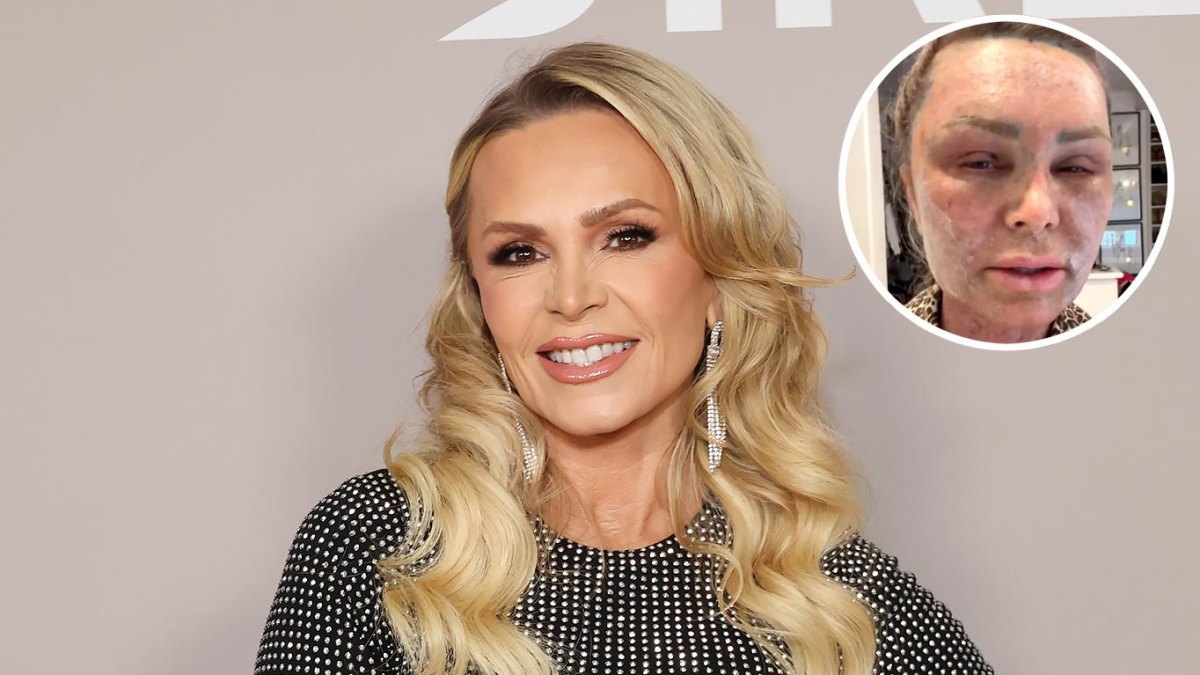 RHOC's Tamra Judge Is Swearing off Plastic Surgery After Brow Lift, Chemical Peel