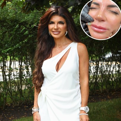 RHONJ’s Teresa Giudice Dissolves Her Lip Filler in Graphic Video: ‘A Little Bit Nervous’