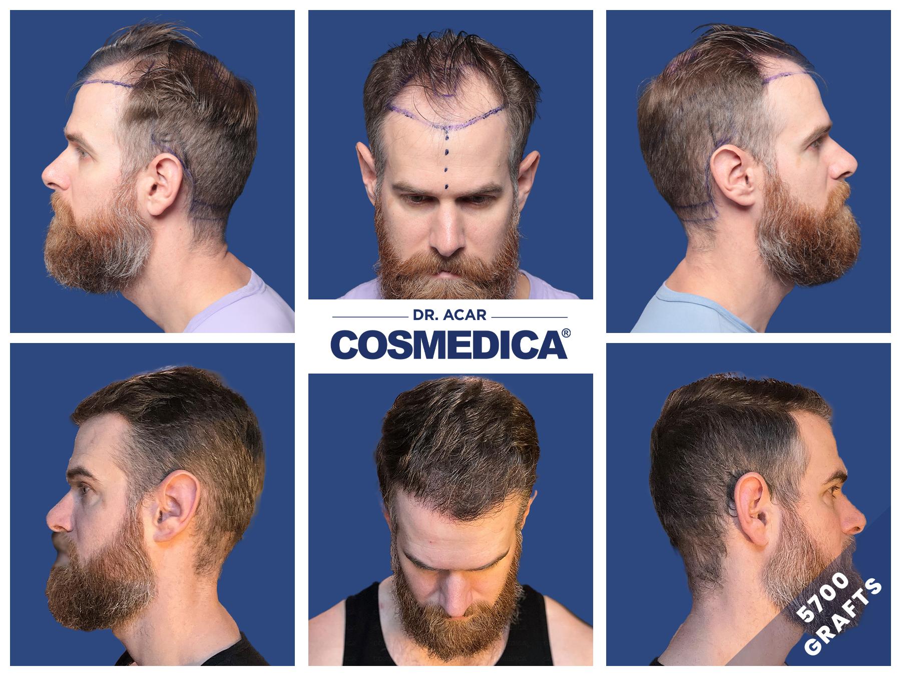 patient undergoing hair transplant procedure in Turkey clinic