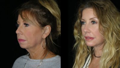 Cosmetic surgery trends continue to evolve as more patients seek subtle facial rejuvenation.