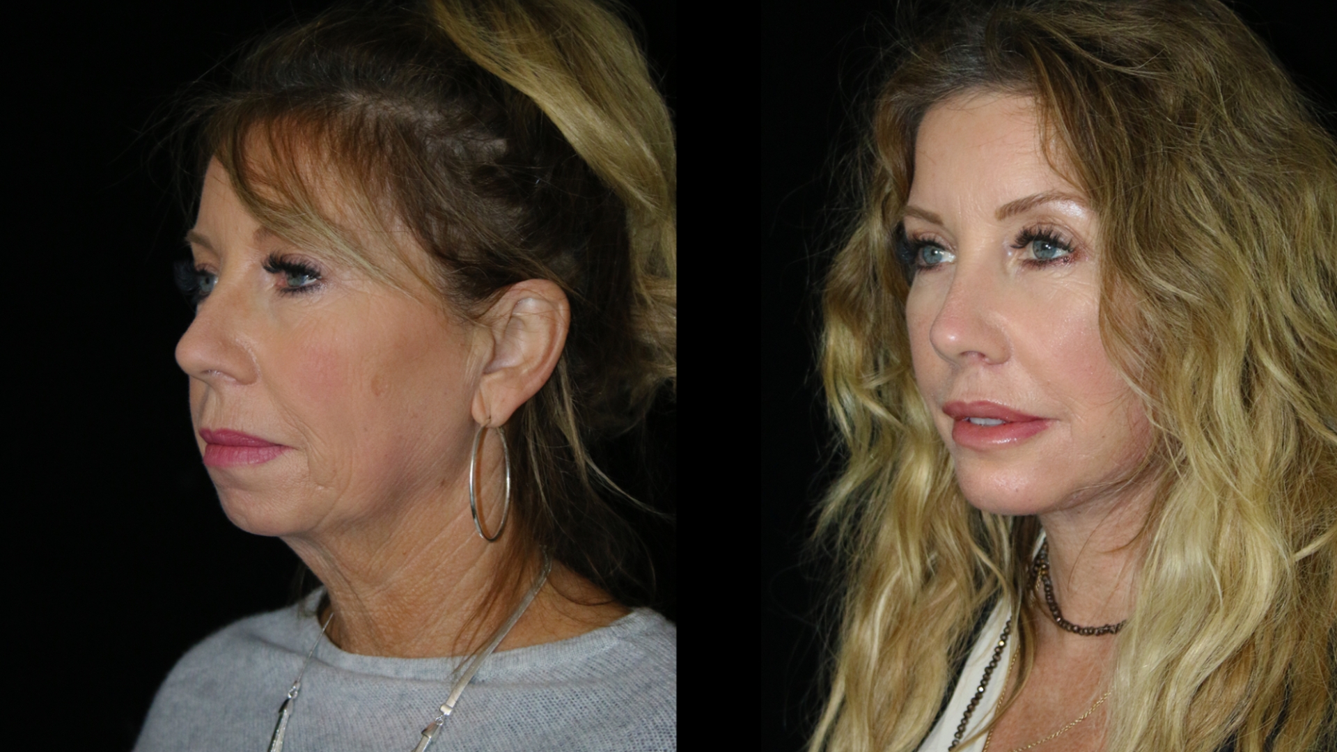 Cosmetic surgery trends continue to evolve as more patients seek subtle facial rejuvenation.