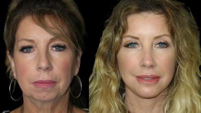 Discover the facial procedures patients are requesting most, from deep plane facelifts to fat grafting, with insights from Dr. Steven R. Cohen.