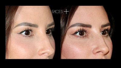 Facial procedures are increasingly focused on natural-looking, individualized results.