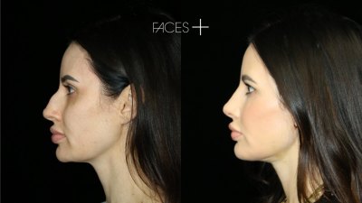 Cosmetic surgery trends continue to evolve as more patients seek subtle facial rejuvenation.
