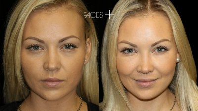 Facial procedures are increasingly focused on natural-looking, individualized results.