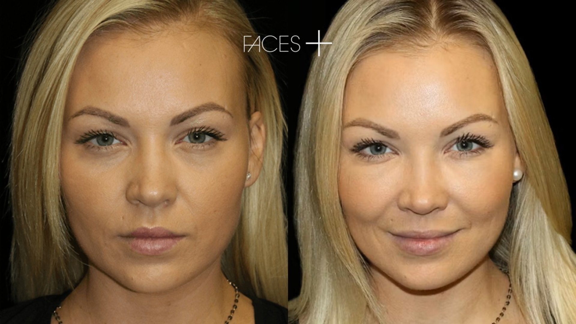 Facial procedures are increasingly focused on natural-looking, individualized results.