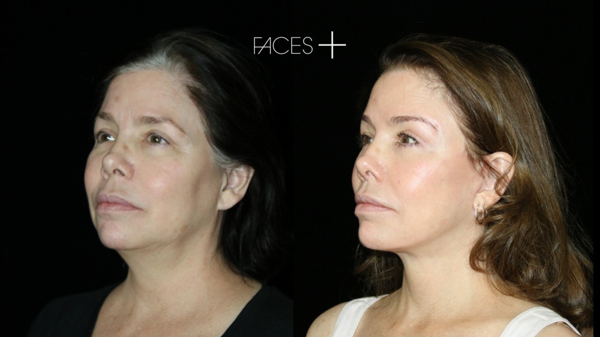 Cosmetic surgery trends continue to evolve as more patients seek subtle facial rejuvenation.