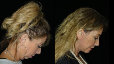 Facial procedures are increasingly focused on natural-looking, individualized results.